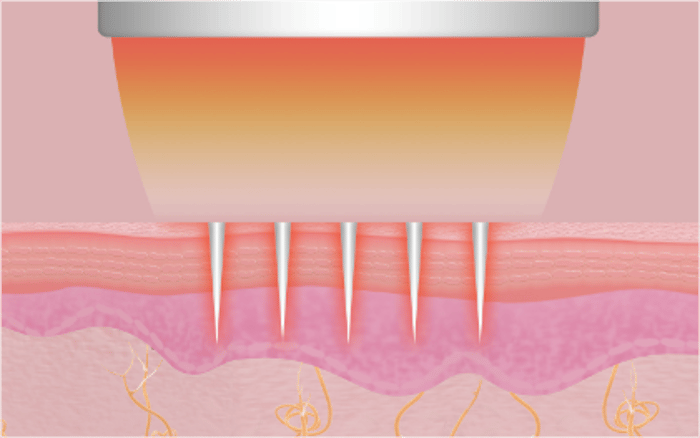 Schritt 3 – RF-Energie induziert Gewebeerneuerung