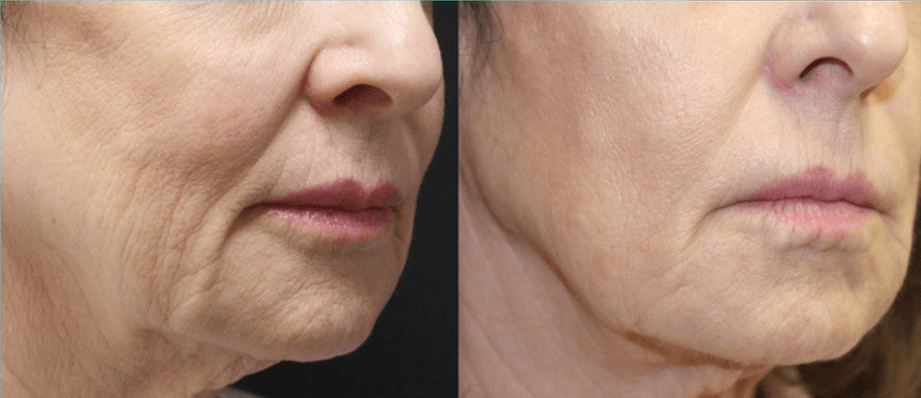 Secret RF Microneedling in Jena – Ausgangssituation vor der Behandlung