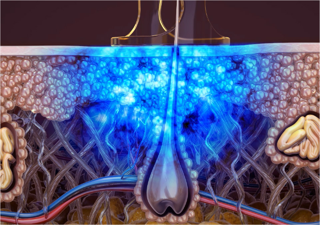 PENTO Systemansicht – Laserhaarentfernung im Studio Jena