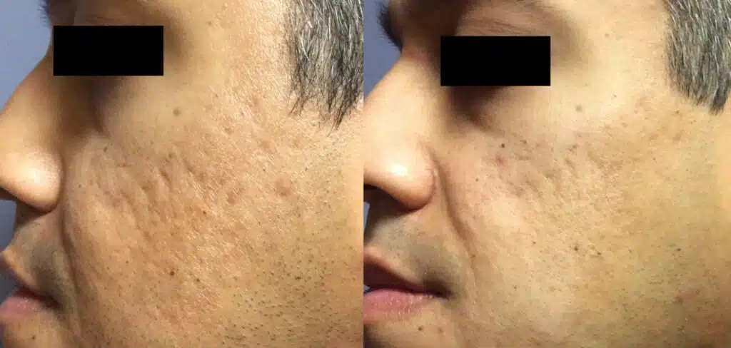 Secret RF Microneedling in Jena – Ausgangssituation vor der Behandlung