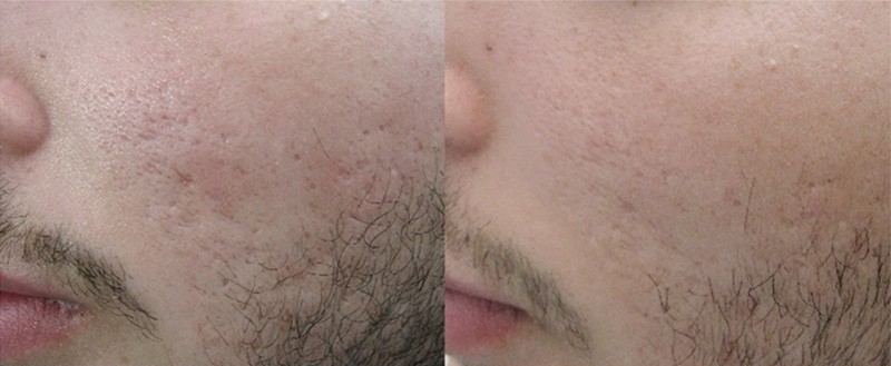 Secret RF Microneedling in Jena – Ausgangssituation vor der Behandlung