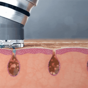 Prinzipdarstellung: Wirkstofflösung und Vakuum an der Hautoberfläche